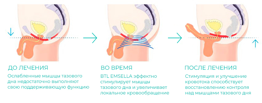 Emsella график
